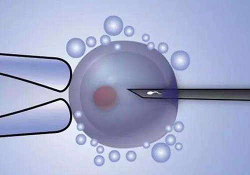 在美國(guó)做試管嬰兒需要多少錢?